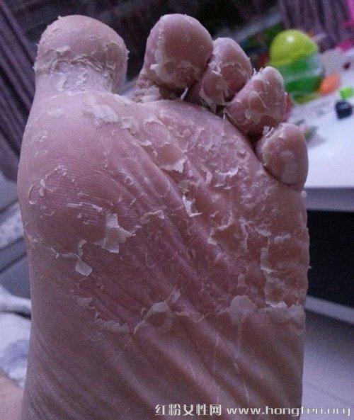 日常治愈脚气的一些方法和养生偏方(5)