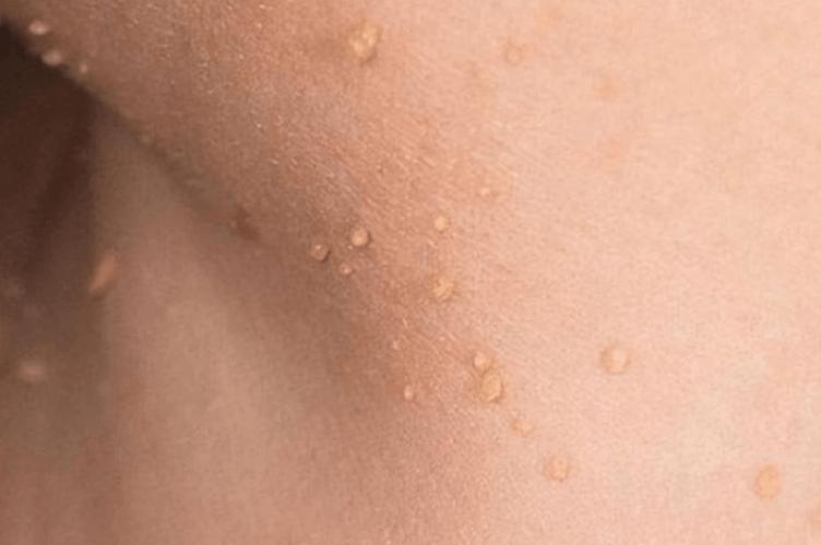 女子腋下长满"小肉条",因确诊感染hpv?医生:切忌别再