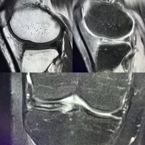 小小半月板之半月板损伤