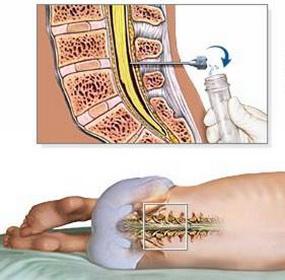 腰椎穿刺的并发症