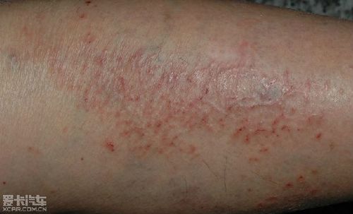 如何预防和治疗冬季皮炎呢?