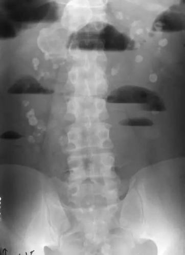 肠梗阻为什么会出现气液平面