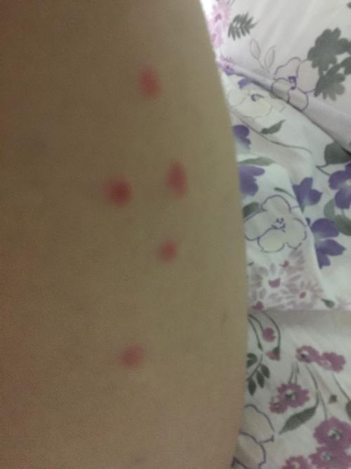 不疼,就是痒,就被我抓成了这样,有的朋友说是水土不服,有的人说是痱子