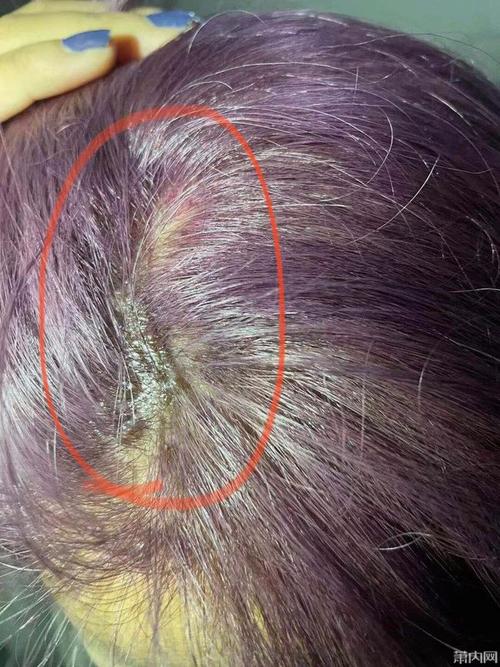 萧山一姑娘染发当场痛哭头皮糜烂进医院半个月不能洗头