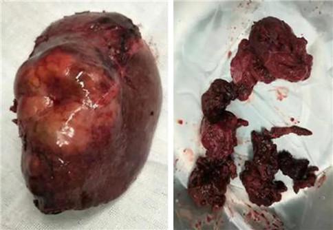 完整的肝癌病灶(左)     多发肝血管瘤(右)