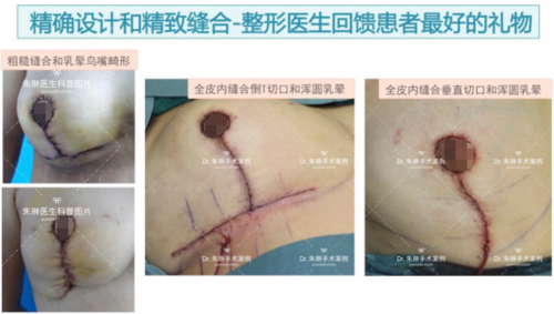 乳房缩小上提术,一定要有切口吗?怎样让瘢痕不明显呢?