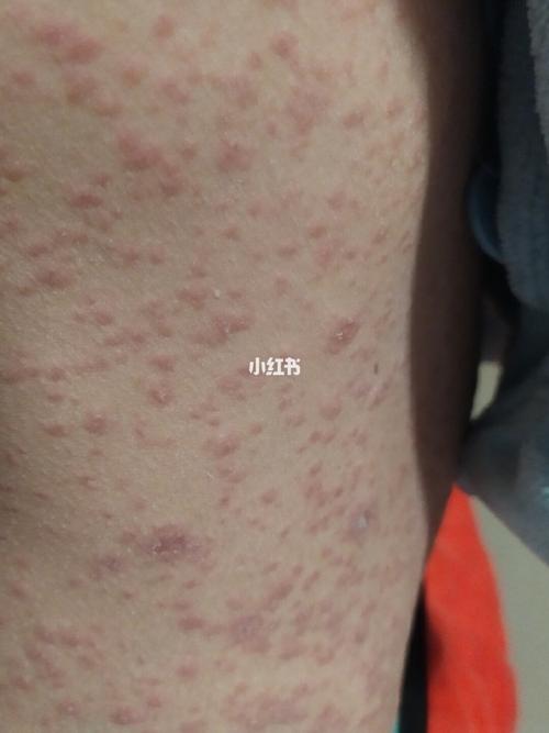 玫瑰糠疹_药品_医疗健康_医疗药品