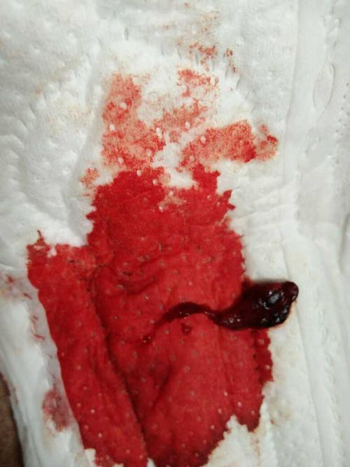 这是不是自然流产了