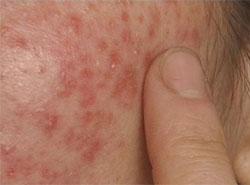  p>光敏性皮炎是由于患者对 a target="_blank" href="/item/紫外线