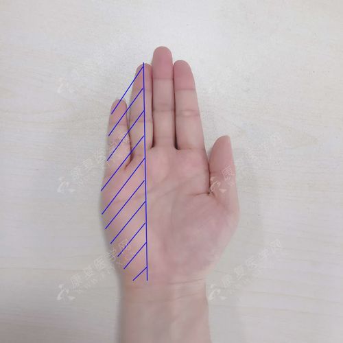 查体可见手部小鱼际肌肌力减退