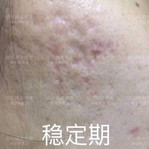 这个阶段对痘坑基底的颜色会有一个调整变化,特别有些痘坑是白色的后