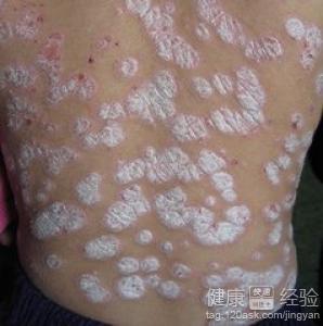 安阳安阳县副银屑病安阳安阳县什么是神经性皮炎