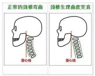 查出颈椎生理曲度变直,怎么恢复?专家教你几招!