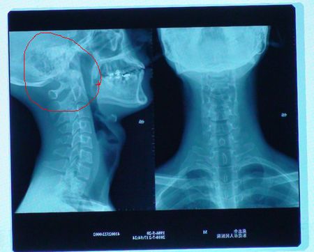 颈椎医学,朋友们,请问我为什么会头痛,看我x光片.