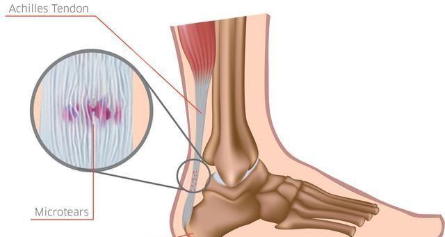 腘肌肌腱炎,主要的病因是什么?患者的症状有些什么?如何治疗?