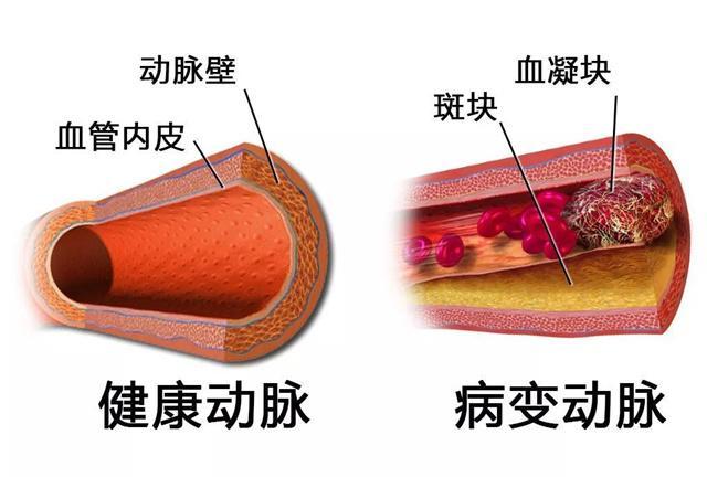 血管里的斑块是什么?发现斑块怎么办?吃药和锻炼能清除么?