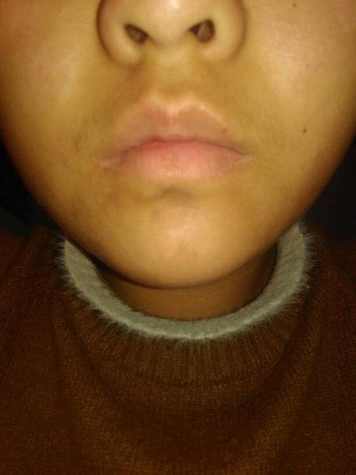 唇毛太浓密怎么办