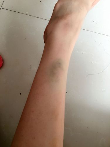 病人:15岁 病情:今天中午发现在自己小腿有一块淤青,按压疼不按压不会