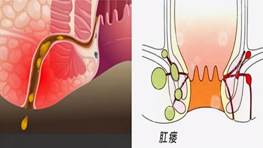 一是肛瘘手术不彻底; 二是虽然手术做彻底,但是没有好好换药; 三是术