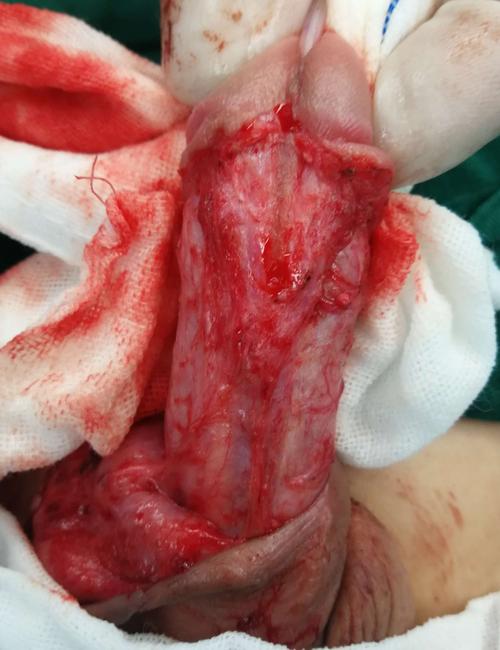 膜性尿道伴弯曲型尿道下裂的处理