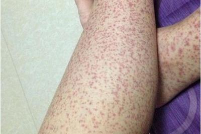 轻度单纯性紫癜图片