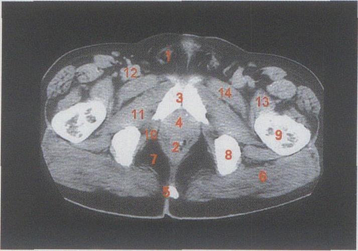 (图) 男性盆部横断层ct像(2)-人体解剖学标本-医学