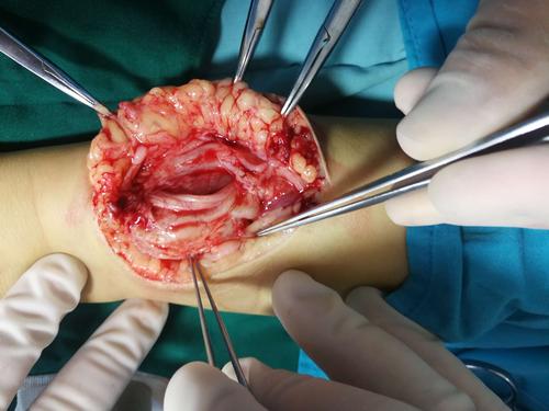 前臂神经纤维瘤