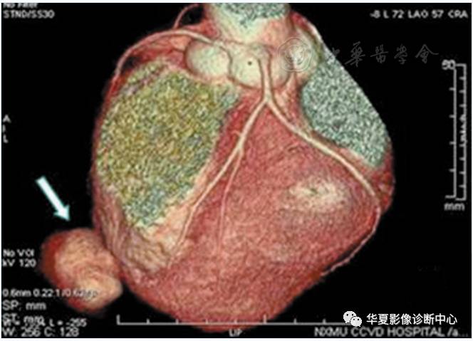 图1胸部ct示右室心尖部囊袋样结构与心室同步强化(箭头所指)胸部ct
