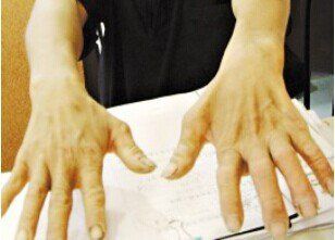 三,肌肉萎缩患者的保健措施