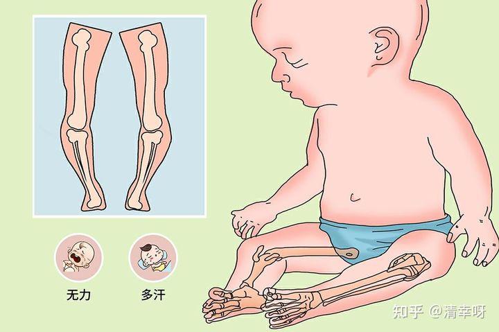 佝偻病的致病原因是什么?该如何预防和日常护理呢?