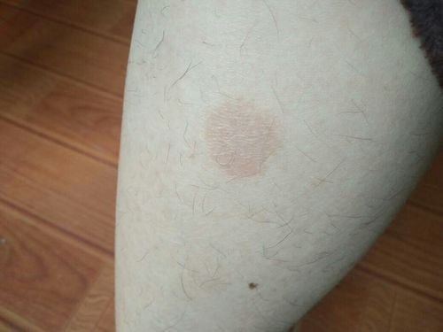 这是不是癣,要是的话是什么癣,不痒