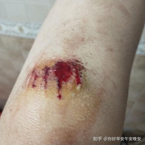 膝盖摔伤,抹了碘伏结痂后如何防止留疤?