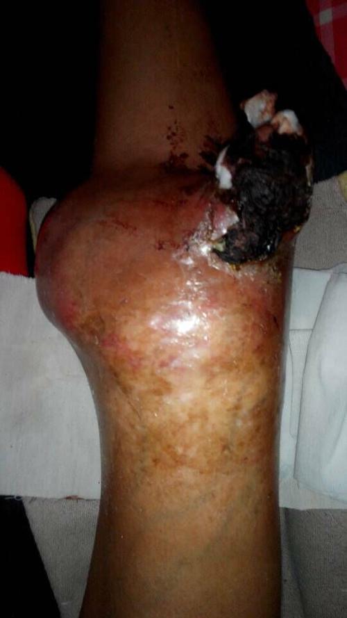 我想请大家帮助一个骨癌女患者患者