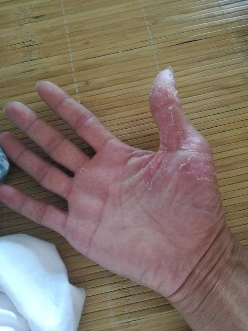 我的手皮炎烂成这样怎么治啊