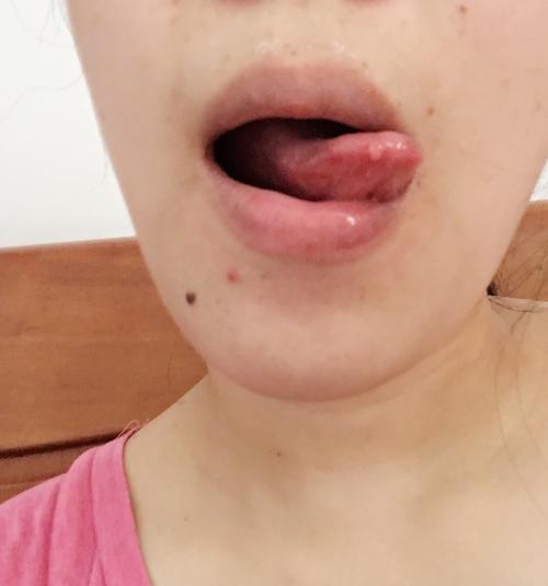 舌尖上长口腔溃疡怎么办 一动就碰到牙齿上 吃东西疼 讲话也疼