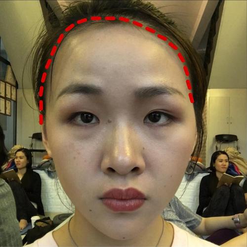 发际线高不平衡|单侧颧骨突出|单侧下垂|眉毛一高一低
