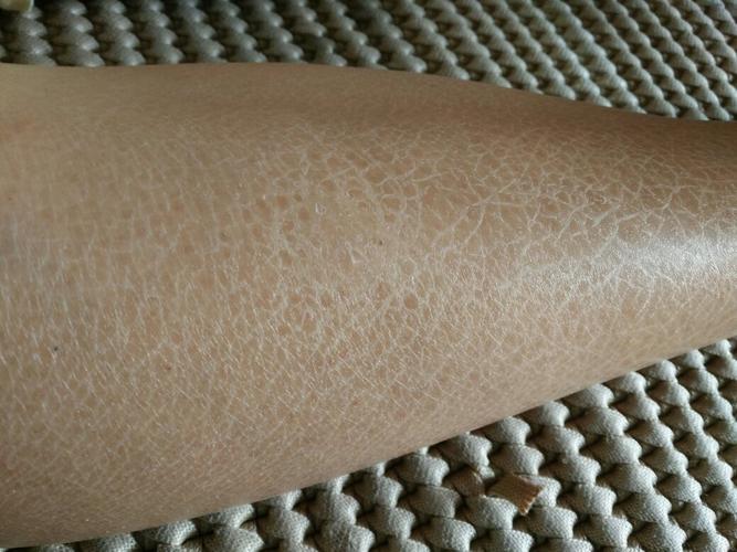 大腿表面有像鱼鳞一样的!是怎么回事?