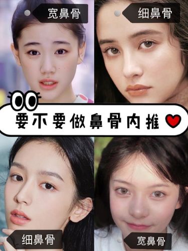 【要不要做鼻骨内推】-〈1〉鼻骨影响了什么