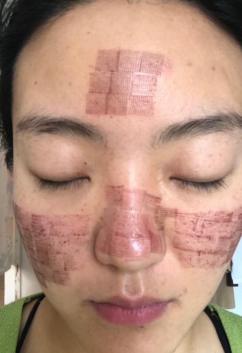 上个月做了点阵激光,皮肤出现了色沉,到现在激光后的网格状印子还在
