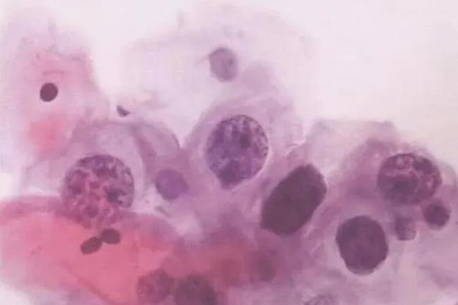 尖锐湿疣复发后长得快吗