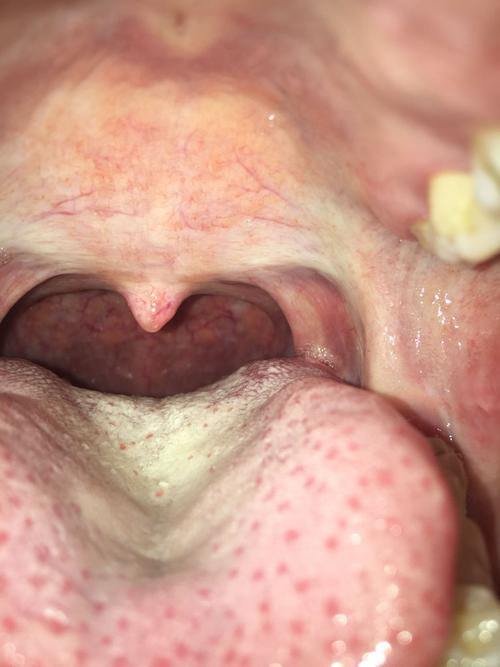 我患的是慢性咽炎,这几天咽炎发作吃东西(咽口水)就喉咙痛,拍个照发现