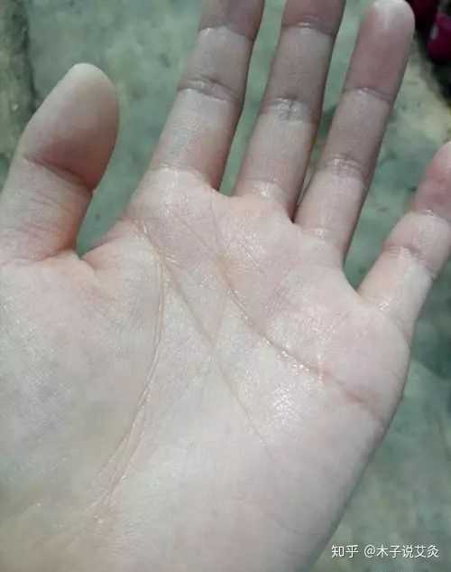女生手心脚心出汗严重怎么办?