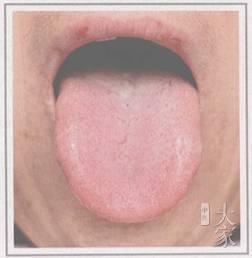 感冒的舌象 ▼风寒感冒