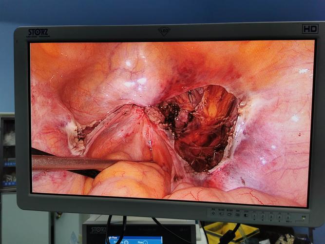 腹腔镜下大子宫腺肌症合并腺肌瘤切除一例