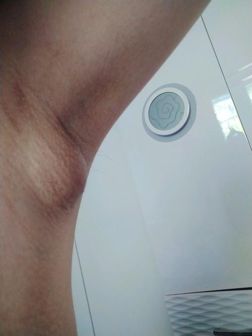 产后13天晚上右侧腋下副乳鼓包