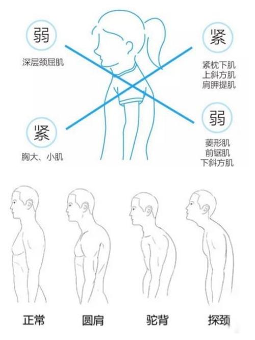 让我们来科普一下上交叉综合症的康复治疗吧.