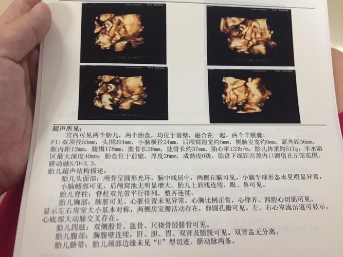 四维彩超检查!双胞胎宝贝的第一张照片好可爱哦!