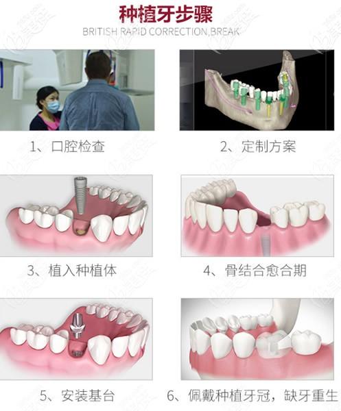 友情提示:钟院长带大家看看种植牙步骤和手术过程