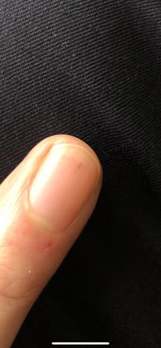 手指甲里面有根小黑线,怎么回事?