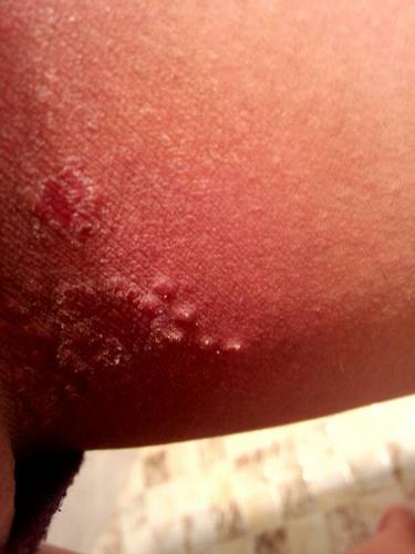 大腿内侧起了很多鲜红色的疙瘩,很痒且好了也会留下红